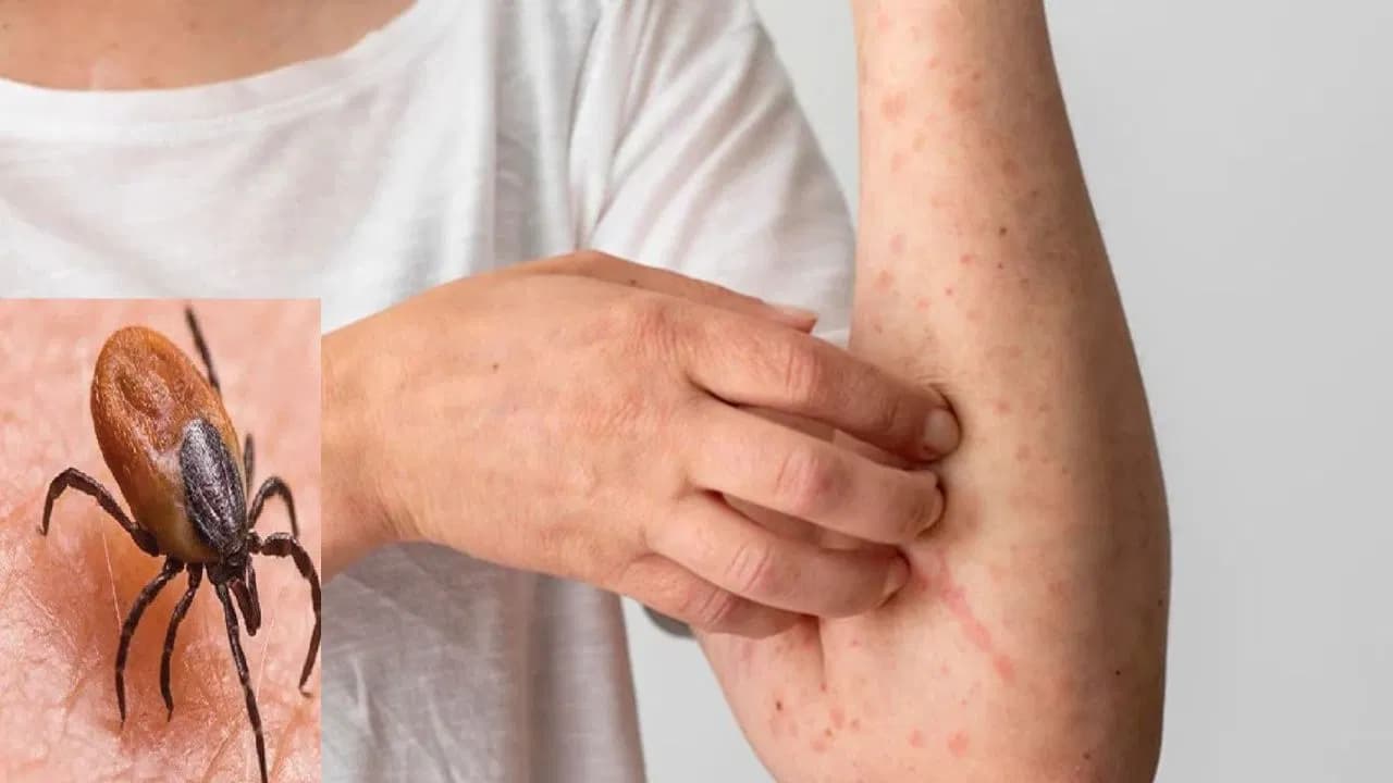 Scrub Typhus Spread Worries Public: Signs to Notice & Protection Measures