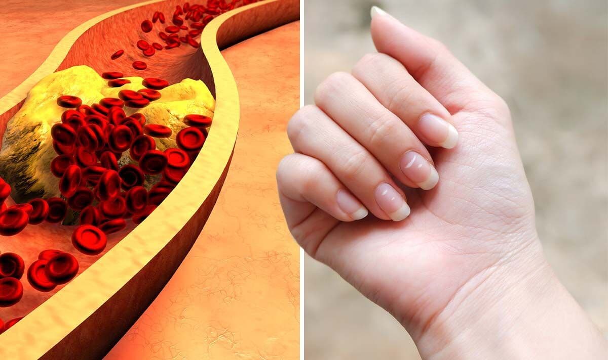 Signs of High Cholesterol in Nails – Doctors’ Warning!