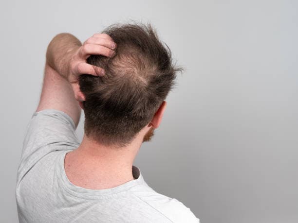 Is your hair falling out excessively during winter? Follow these precautions