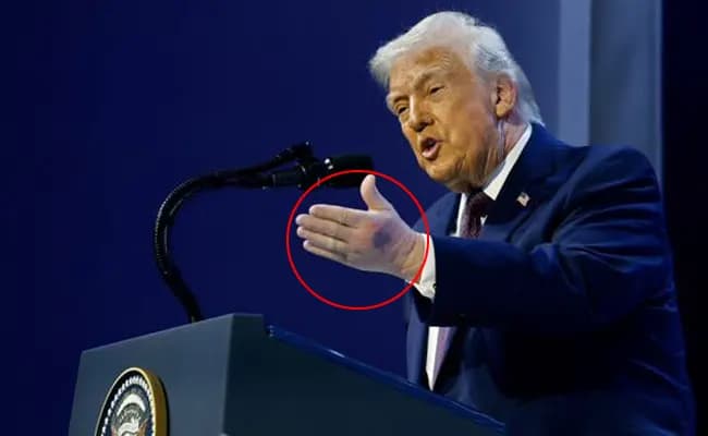 Trump's hand injury sparks renewed concerns about his health