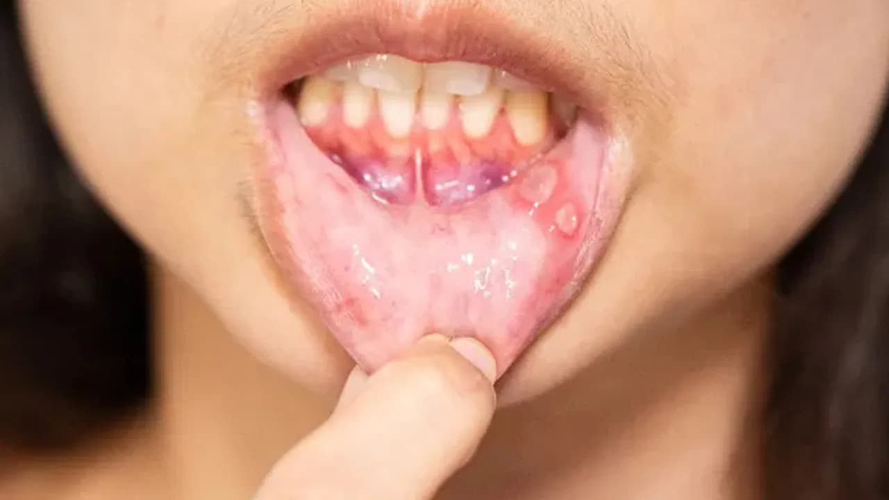 Reddish patches on the tongue and gums may indicate oral cancer, warn doctors